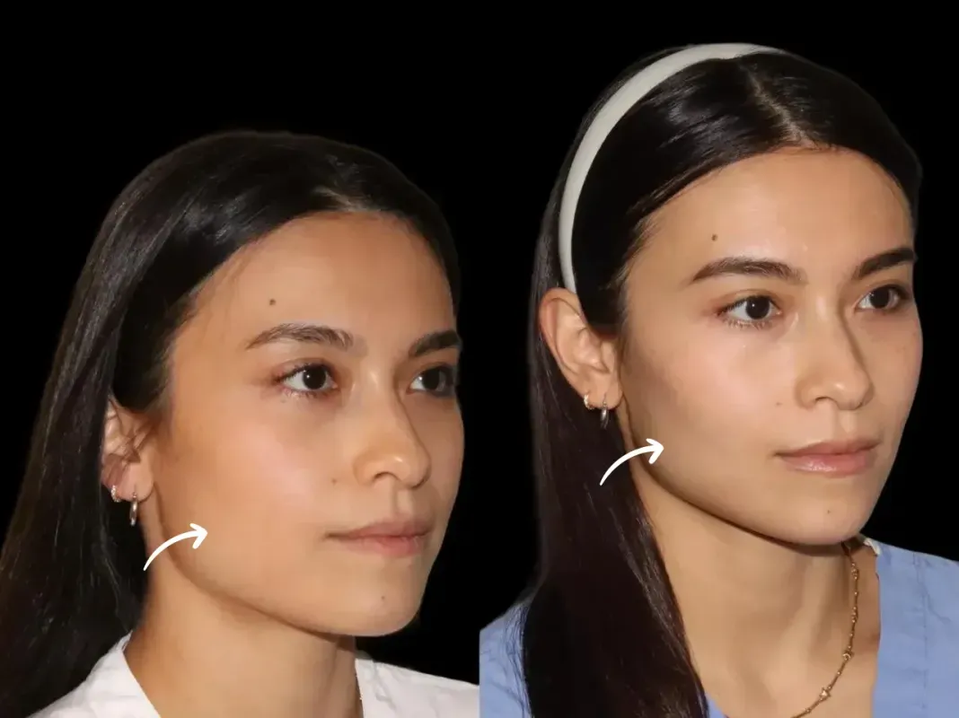 How the Best Plastic Surgeon in Dubai Customizes Sculptra Fillers Results