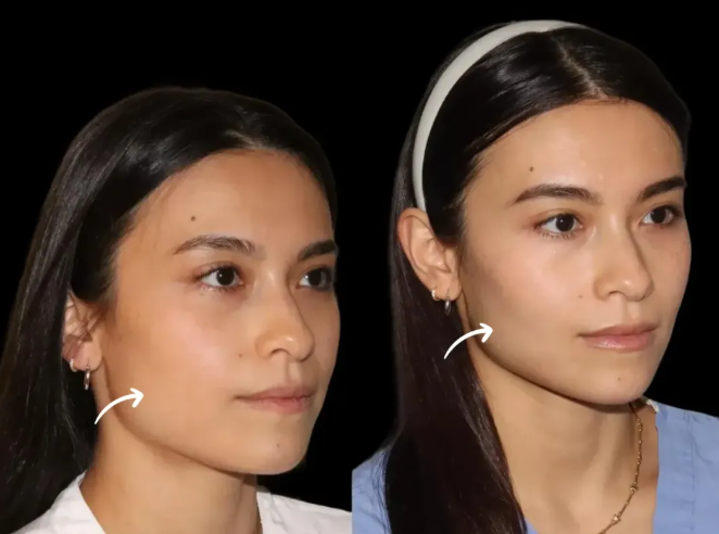 The Role of a Certified Best Plastic Surgeon in Dubai: Safe Sculptra Fillers Injections