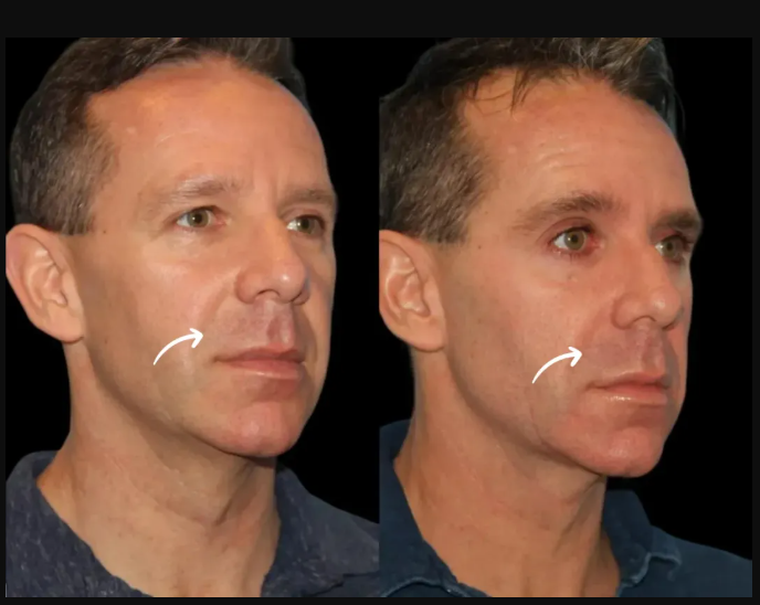 Is Sculptra Fillers Painful? Patient Experiences from Dubai’s Best Aesthetic Clinic