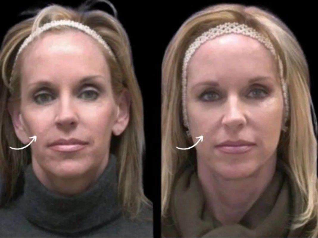Preparation Steps for Sculptra Fillers in Dubai