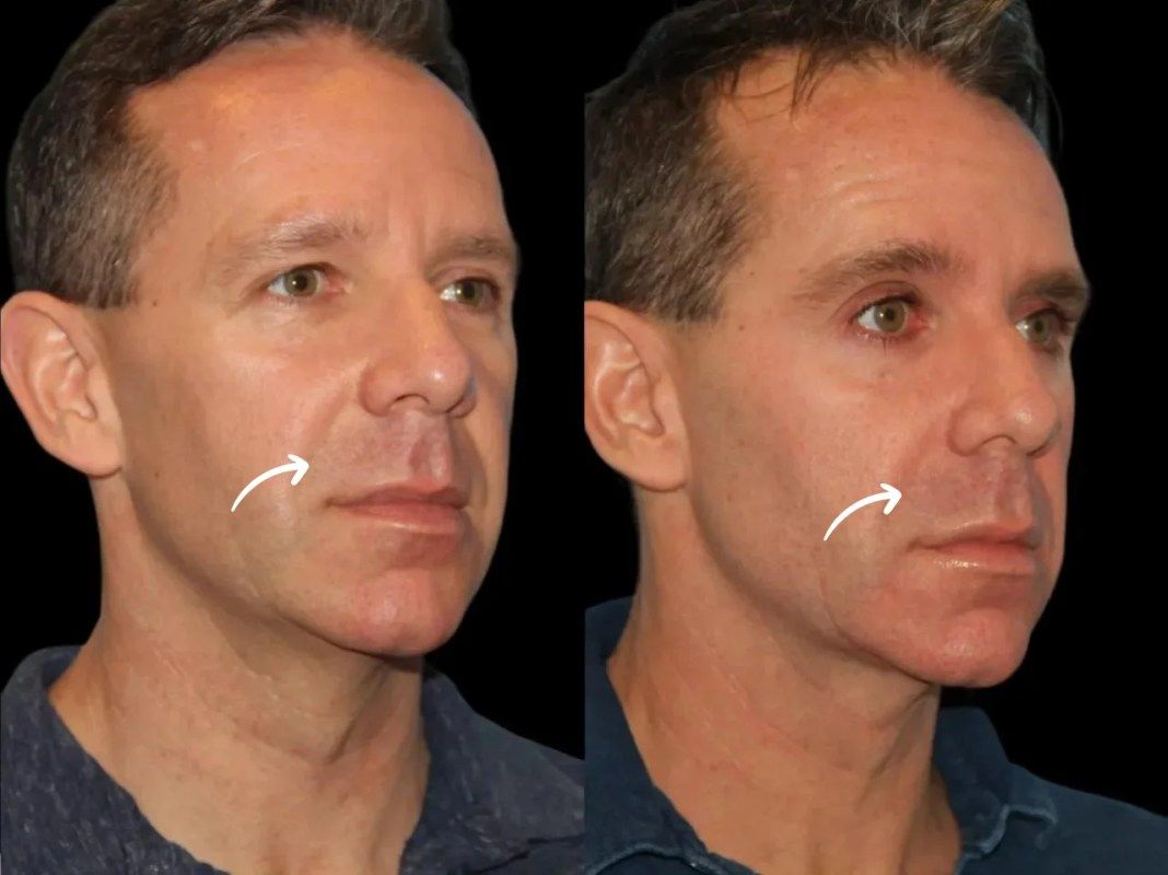 Best Plastic Surgeons in Dubai: Innovation in Sculptra Formulas