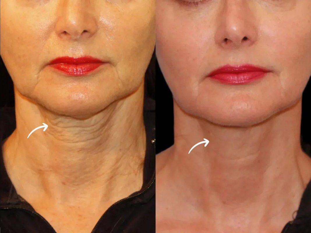 sculptra in dubai