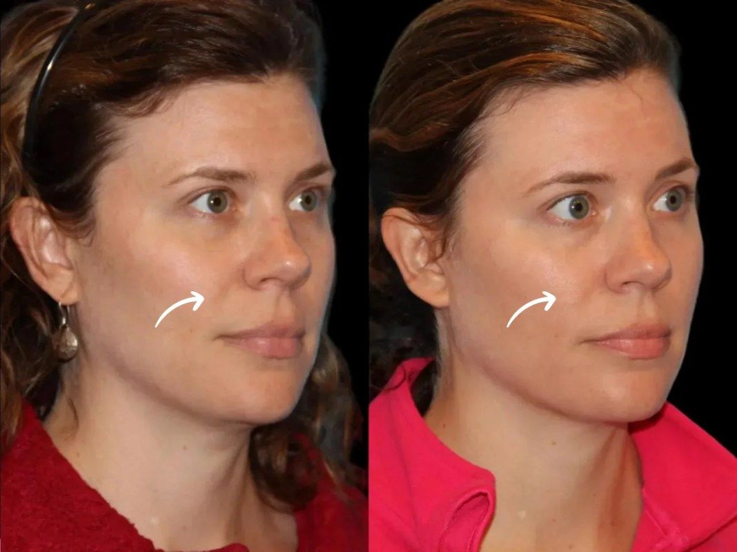 sculptra in dubai